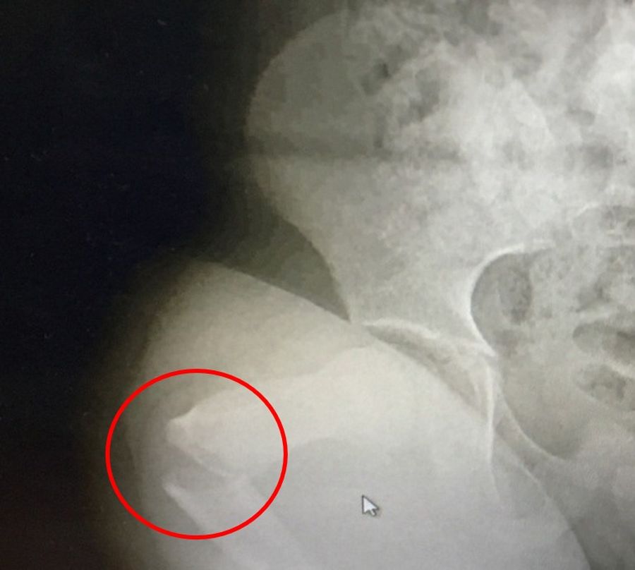 The x-ray showing Dominic's femur