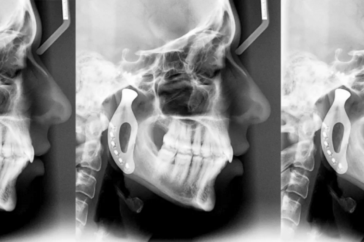 Shapeshifters_Dr David Ackland_3D Printed Jaw