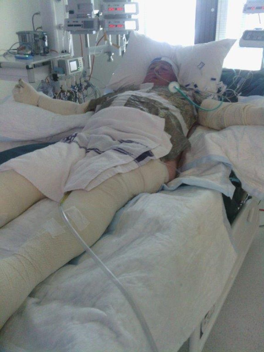 Geoff with burns on bed in Adelaide Hospital