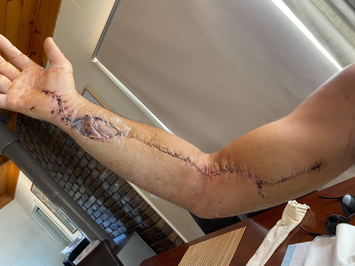 RFDS patient Richy Hobbs injured arm