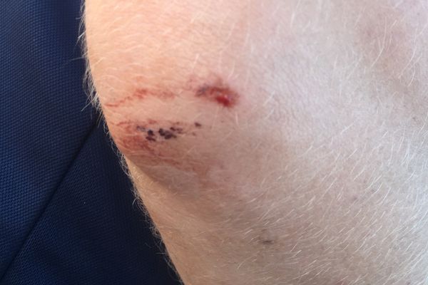 Despite outside appearances, Ben's scratch to the elbow by a Mulga tree packed a big punch!