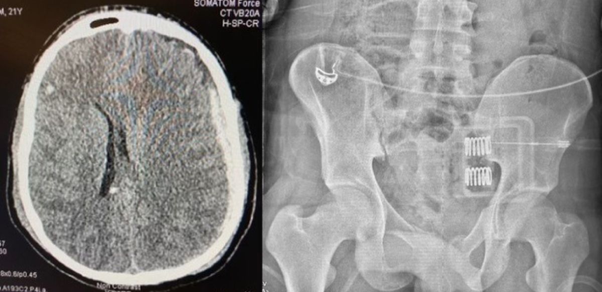 Randal had a severe brain injury