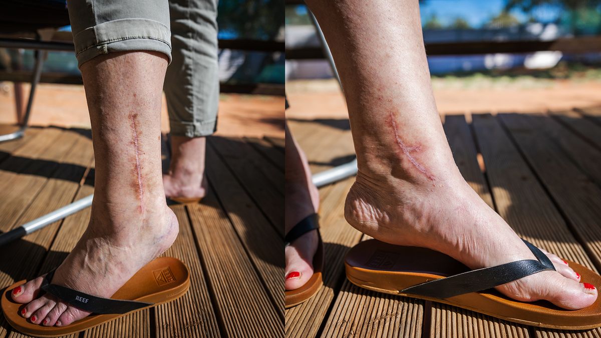 Sandy's scars